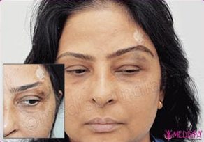 Eyebrow Hair Transplant and Reconstruction Clinic in India