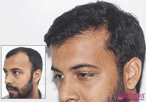 Hairline Reconstruction Centre