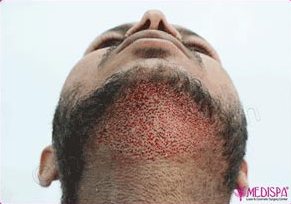 Hair Transplant in Delhi | Hair Transplant Cost in Delhi Clinic Hair Transplant in Delhi | Hair Transplant Cost in Delhi Clinic