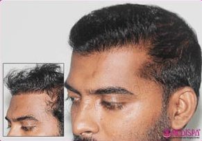 Failed* Hair Transplant Repair