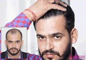 Hair Transplant in Delhi | Hair Transplant Cost in Delhi Clinic Hair Transplant in Delhi | Hair Transplant Cost in Delhi Clinic
